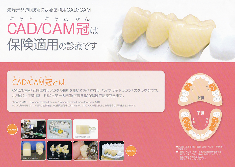 保険の白い奥歯(CAD/CAM冠)